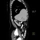 Morgagni hernia with dome of the liver: CT - Computed tomography